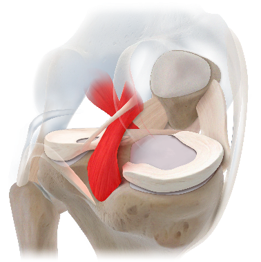 膝枢纽韧带损伤与术式